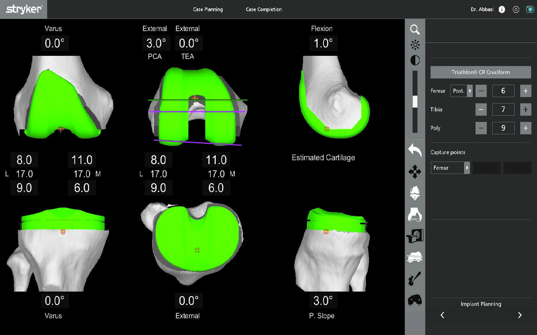 Robotic-assisted TKR with MAKO system at SJMC