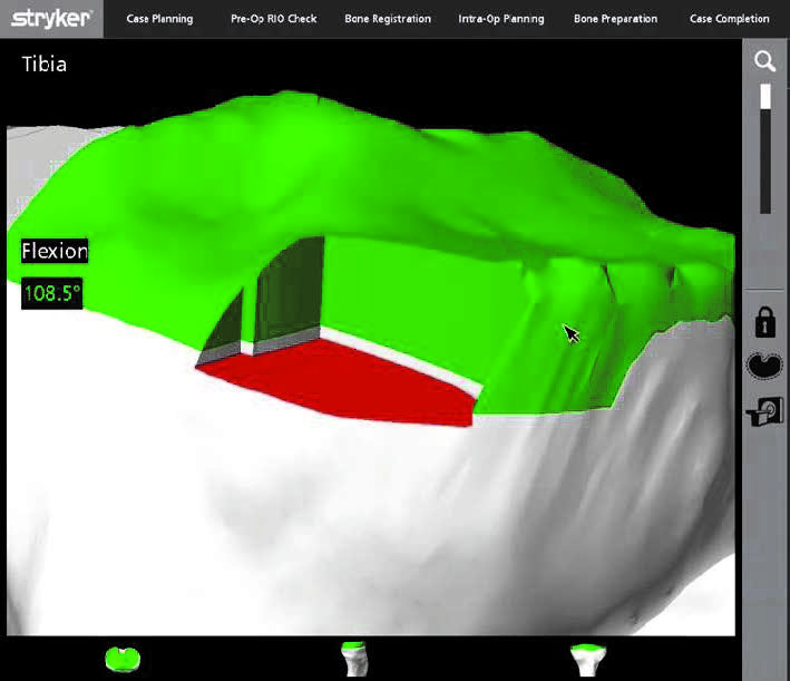 AccuStop Haptic Technology MAKO Robotic Surgery SJMC Malaysia