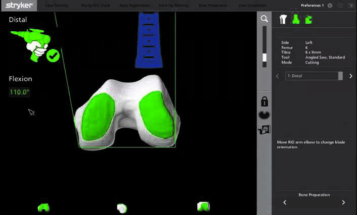 Real-time Visualisation MAKO Robotic Surgery SJMC Malaysia