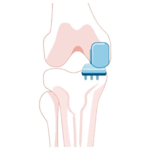 Partial Knee Replacement MAKO Robotic Surgery SJMC Malaysia