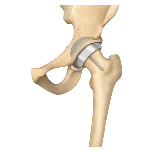 Surface Hip Replacement MAKO Robotic Surgery SJMC Malaysia