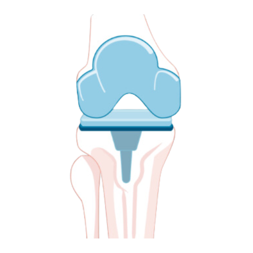Total Knee Replacement (TKR) at SJMC Malaysia