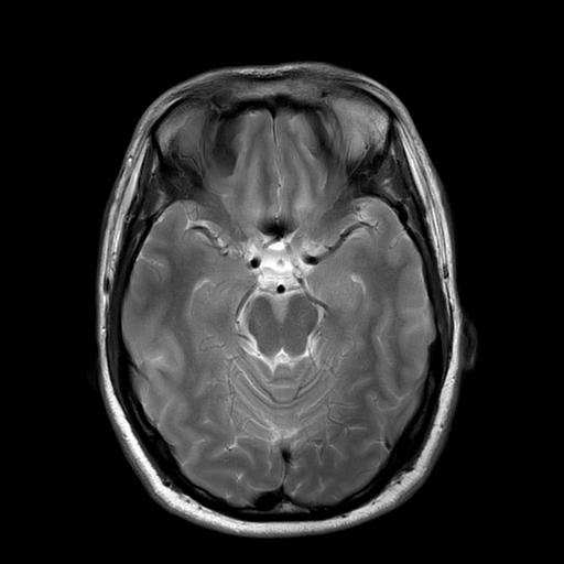 MRI images of the brain