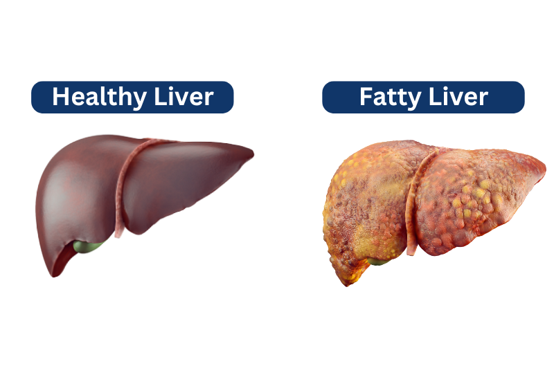 Fatty liver vs healthy liver malaysia